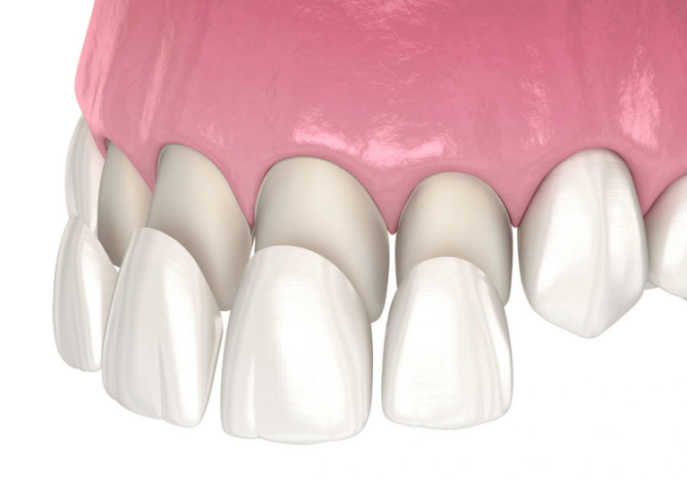 A 3D illustration of a dental procedure showing the placement of dental veneers on the upper front teeth. The image depicts the veneers being positioned over the natural teeth, highlighting the process of cosmetic dental enhancement.