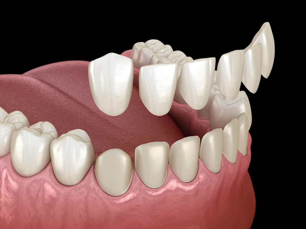 Digital rendering of a mouth getting veneers placed over the existing teeth.